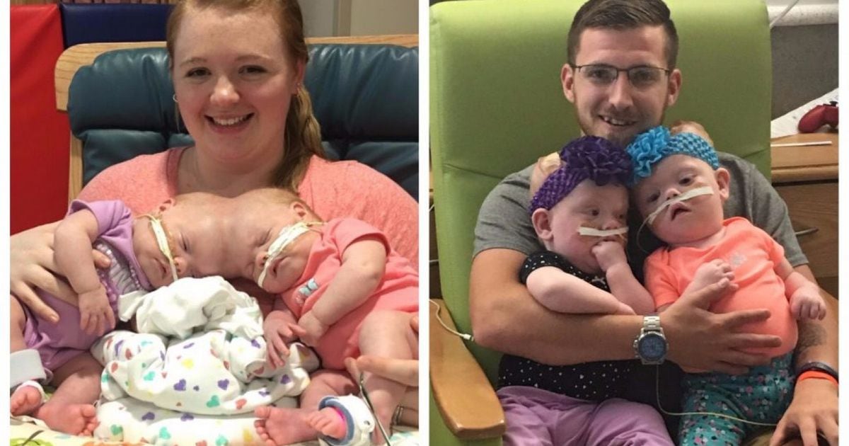 Conjoined twins survived one of the world's rarest surgeries. Now they